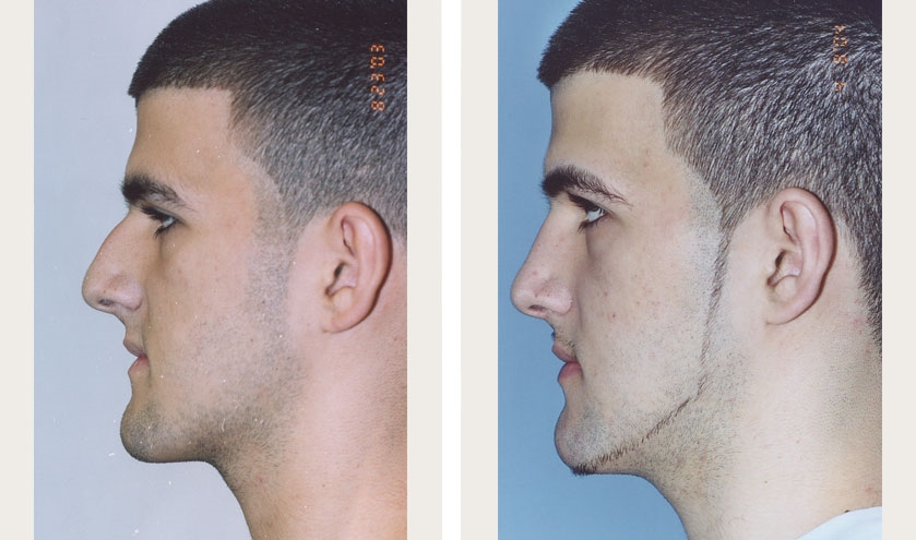 endonasal rhinoplasty