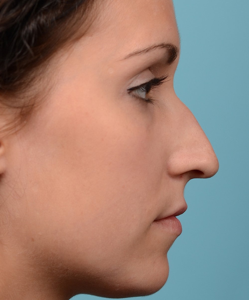 endonasal rhinoplasty
