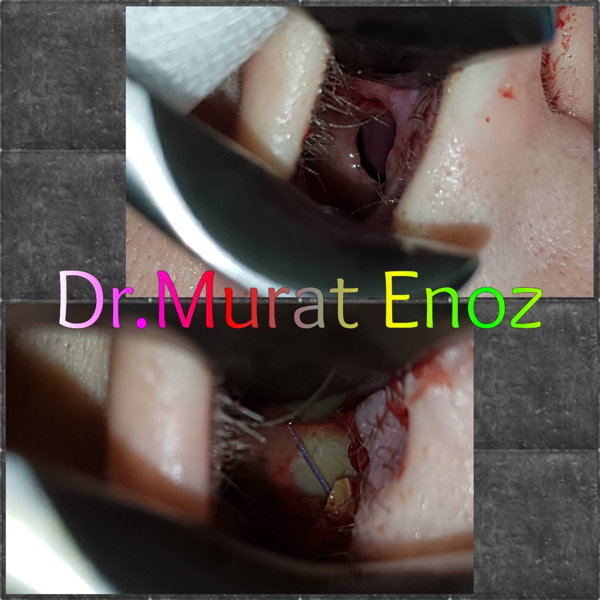 endonasal rhinoplasty