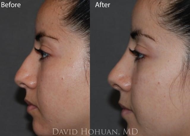 rhinoplasty surgery cost